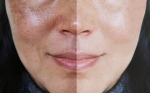 Cum poti trata porii dilatati