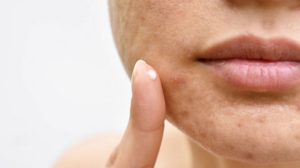 Pasii care te vor ajuta sa previi acneea